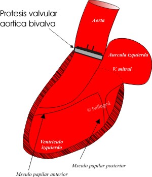 Reemplazo de la bateria aorta ascendente tamano