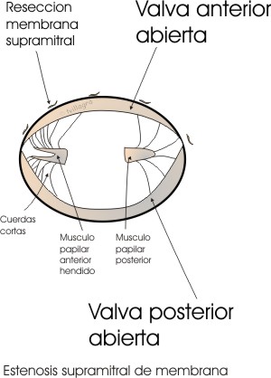 A entrada da valvula mitral